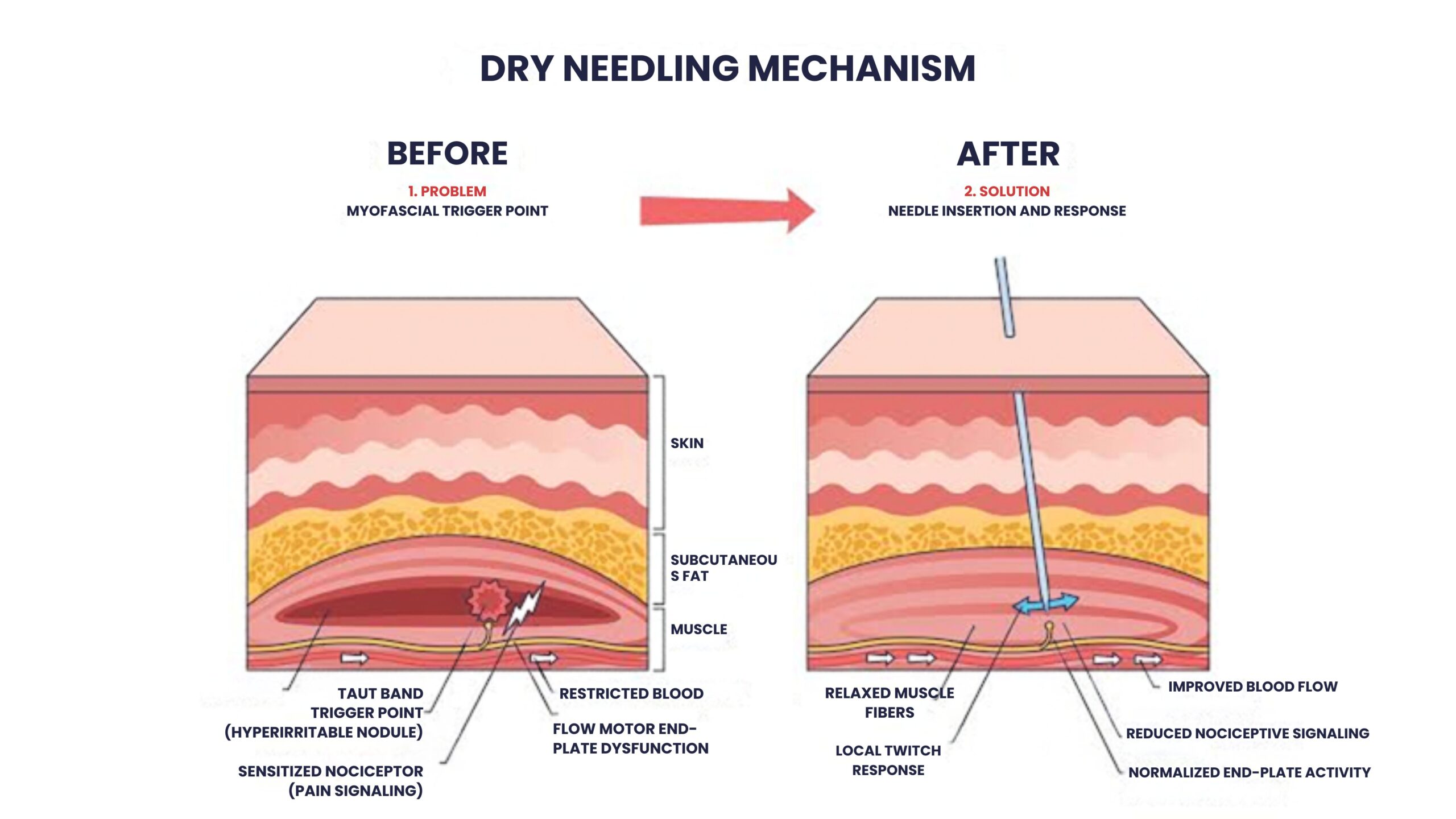 Dry needling physiotherapy at home in Delhi NCR